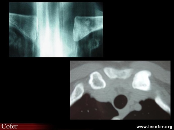 Ostéose condensante de la clavicule : maladie de Brower