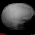 Crâne pagétique, maladie de Paget (vue de profil)