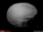 Crâne pagétique, maladie de Paget (vue de profil)