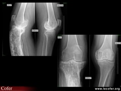 Maladie de Paget du tibia et condyle fémoral