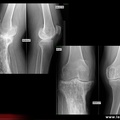 Maladie de Paget du tibia et condyle fémoral