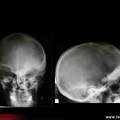 Dysplasie fibreuse des os de la base du crâne