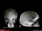 Dysplasie fibreuse des os de la base du crâne