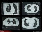 Maladie de Wegener : atteinte pulmonaire