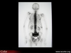 Fracture du sacrum, aspect scintigraphique d’une fracture du sacrum par insuffisance osseuse