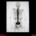 Fracture du sacrum, aspect scintigraphique d’une fracture du sacrum par insuffisance osseuse