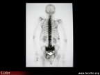 Fracture du sacrum, aspect scintigraphique d’une fracture du sacrum par insuffisance osseuse