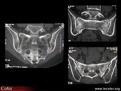 Fracture du sacrum par insuffisance osseuse visible au scanner