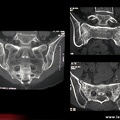 Fracture du sacrum par insuffisance osseuse visible au scanner