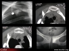 Arthrite sterno-costo-claviculaire droite au cours d’un syndrome SAPHO