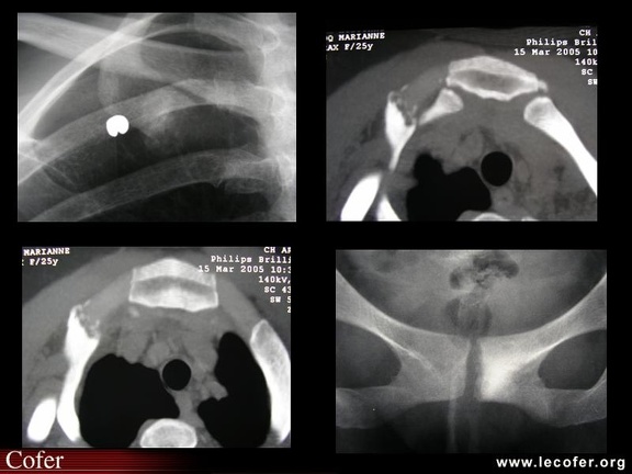 Arthrite sterno-costo-claviculaire droite au cours d’un syndrome SAPHO