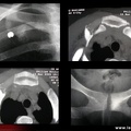 Arthrite sterno-costo-claviculaire droite au cours d’un syndrome SAPHO