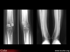 Syndrome de Camurati-Engelmann : membres inférieurs