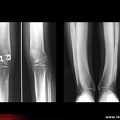 Syndrome de Camurati-Engelmann : membres inférieurs
