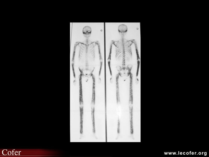 Syndrome de Camurati-Engelmann : scintigraphie osseuse