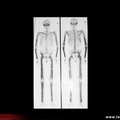 Syndrome de Camurati-Engelmann : scintigraphie osseuse