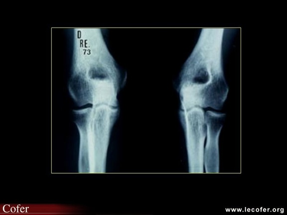 Évolution radiologique dans la polyarthrite rhumatoïde : radiographies du coude normales au départ de la maladie