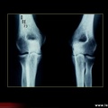 Évolution radiologique dans la polyarthrite rhumatoïde : radiographies du coude normales au départ de la maladie