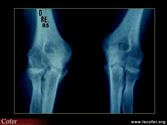 Évolution radiologique au cours de la polyarthrite rhumatoïde : arthrite des deux coudes 12 ans plus tard