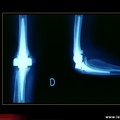 Évolution radiologique au cours de la polyarthrite rhumatoïde : prothèse totale du coude droit quelques années plus tard