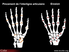 Score radiologique de SENS dans la polyarthrite rhumatoïde