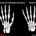 Score radiologique de SENS dans la polyarthrite rhumatoïde