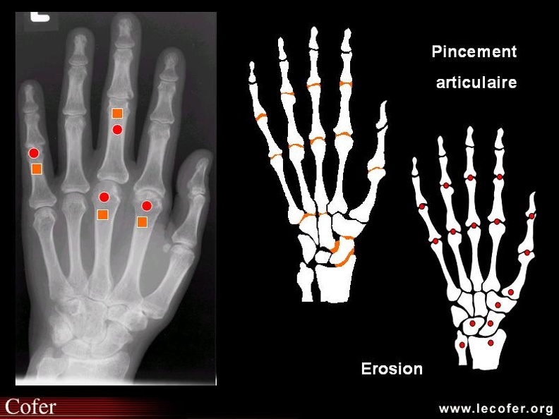 Score radiologique de SENS dans la polyarthrite rhumatoïde. 000000000864s.jpg
