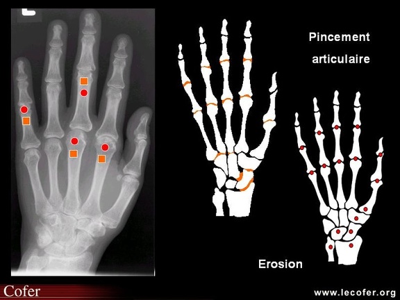 Score radiologique de SENS dans la polyarthrite rhumatoïde