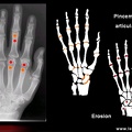 Score radiologique de SENS dans la polyarthrite rhumatoïde