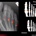 Score radiologique de SENS dans la polyarthrite rhumatoïde