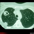 Granulomatose de Wegener : scanner pulmonaire