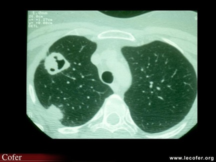 Granulomatose de Wegener : scanner pulmonaire