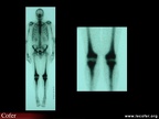 Maladie de Chester-Erdheim : scintigraphie osseuse