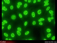 Anticorps AntiNucléaires : AAN sur Hep-2 : AAN moucheté immunofluorescence