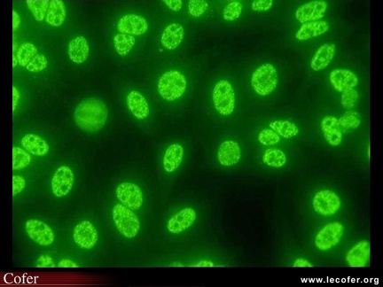 Anticorps AntiNucléaires : AAN sur Hep-2 : AAN moucheté immunofluorescence