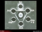 Anticorps anti-antigènes nucléaires solubles  : méthode d’Ouchterlony