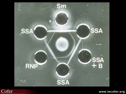 Anticorps anti-antigènes nucléaires solubles  : méthode d’Ouchterlony