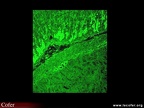 Anticytoplasme sur triple substrat : anti-ribosomes