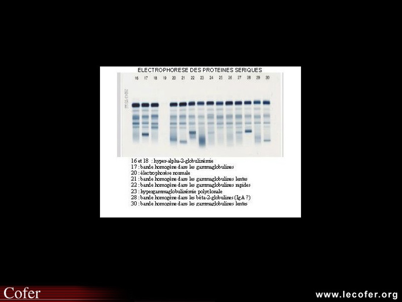 Tracés d'électrophorèse des protéines sériques. De haut en bas : albumine, alpha-1, alpha-2, beta-1, beta-2 et gammaglobulines. 010103001.jpg