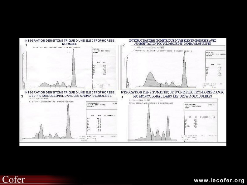 Intégrations densitométriques d’électrophorèses normale et pathologiques