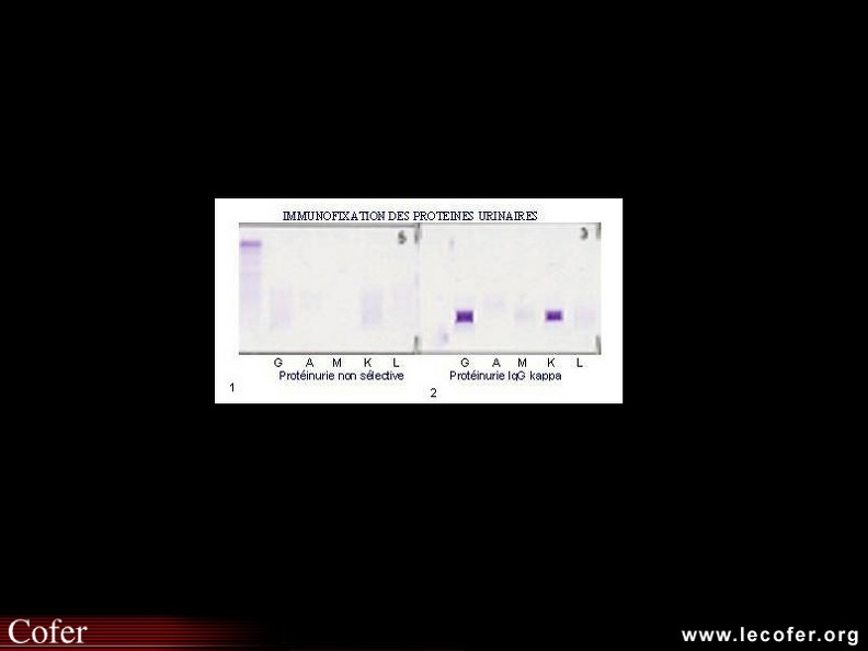 Immunofixation des protéines urinaires