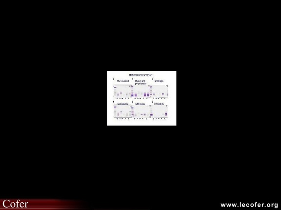 Immunofixation des protéines sériques