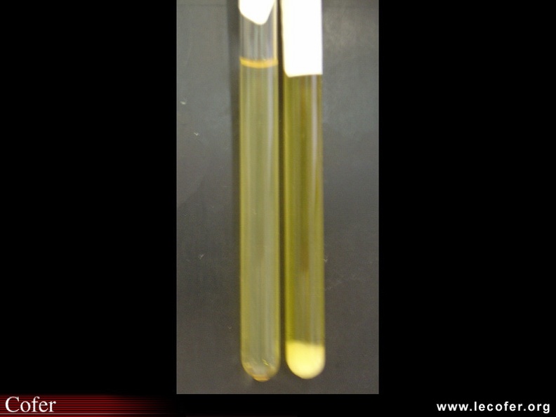 Cryoglobulinémie