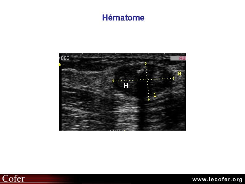 Hématome du muscle vaste interne, échographie