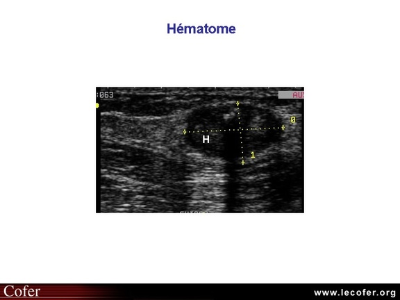 Hématome du muscle vaste interne, échographie