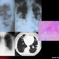 Polyarthrite rhumatoïde, PR, nodules rhumatoïdes pulmonaires
