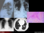 Polyarthrite rhumatoïde, PR, nodules rhumatoïdes pulmonaires