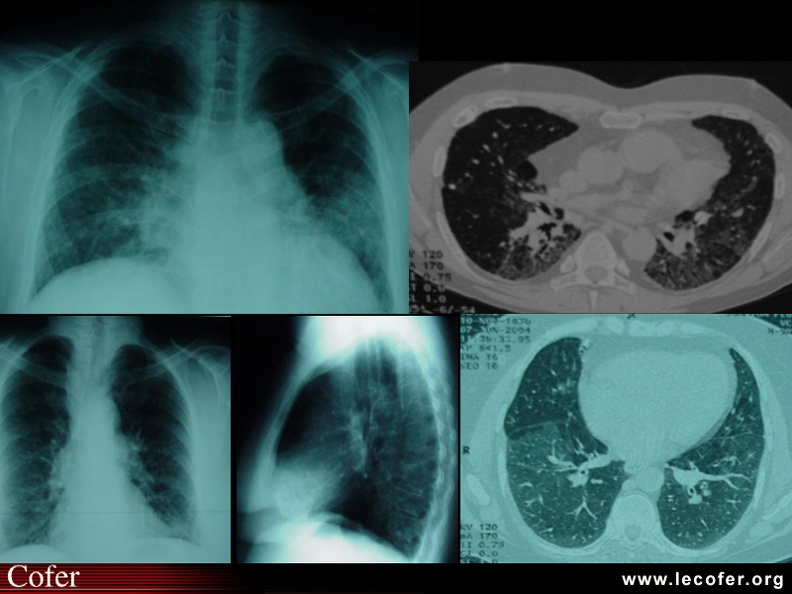 Atteinte pulmonaire dans la polyarthrite rhumatoïde : fibrose, bronchiolite oblitérante. 020103010.jpg