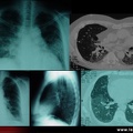 Polyarthrite rhumatoïde, PR : atteinte pulmonaire
