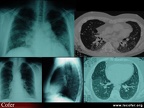 Polyarthrite rhumatoïde, PR : atteinte pulmonaire
